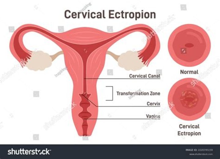 ectropion cervix