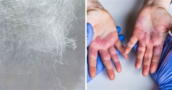 fiberglass in skin
