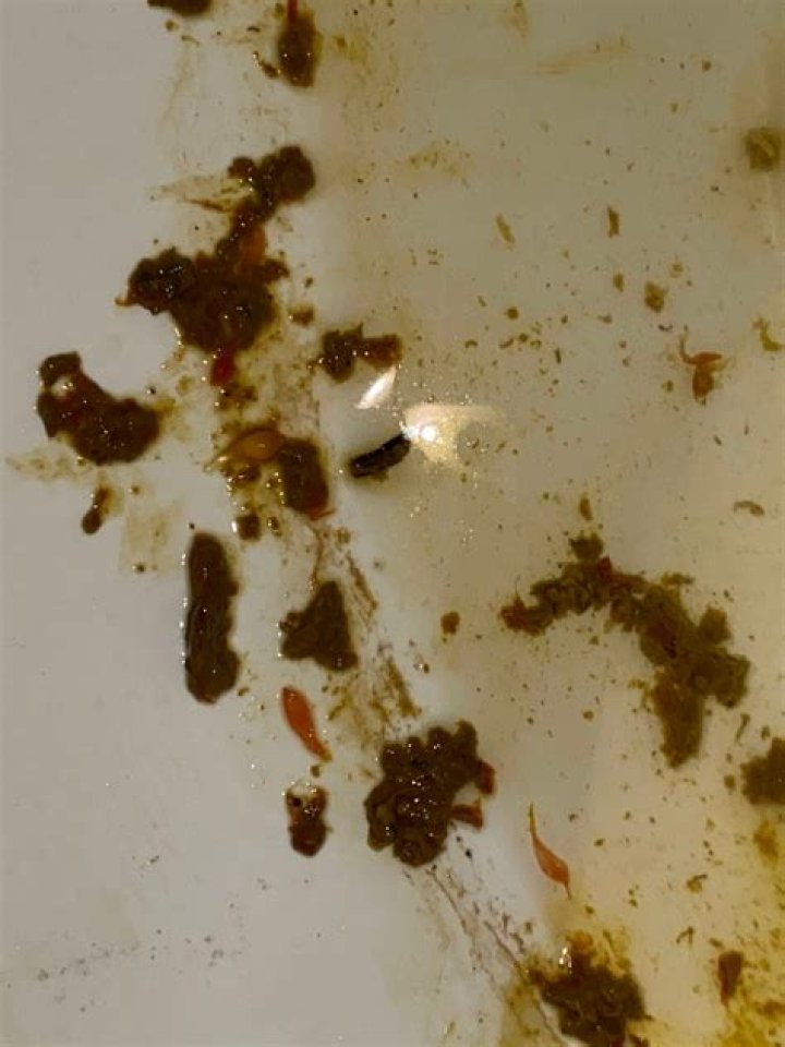 liver flukes in stool