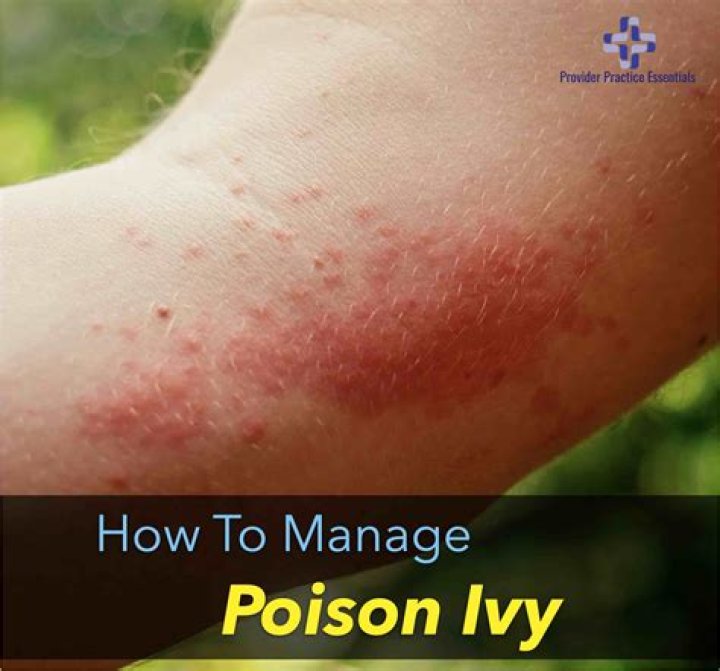 poison ivy in bloodstream symptoms
