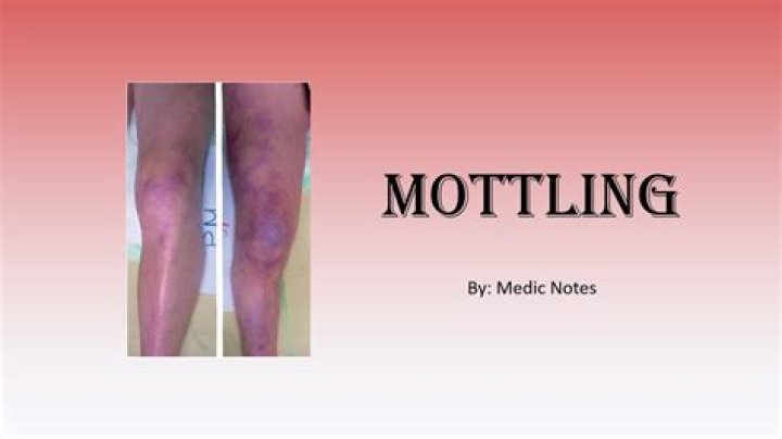 skin mottling