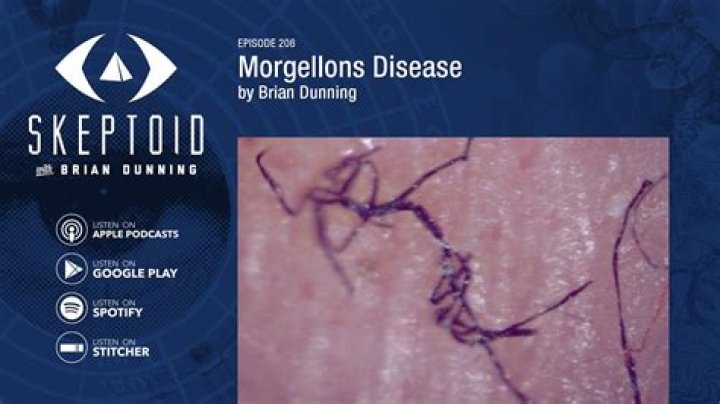 stages of morgellons disease