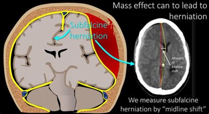 subfalcine herniation