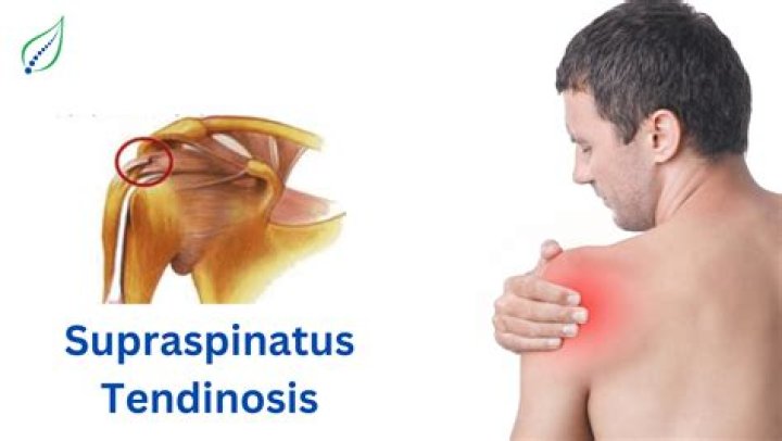 supraspinatus tendinosis