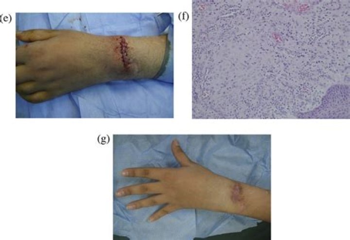 suture granuloma