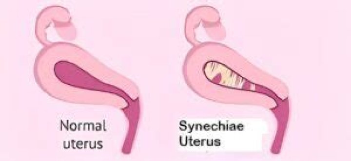 uterine synechiae