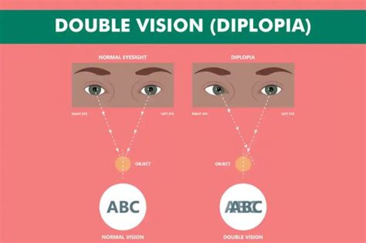 what is diplopia
